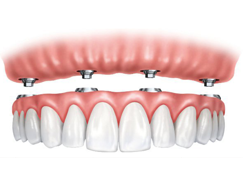 Implant Supported Dentures Fixed Implant Supported Dentures