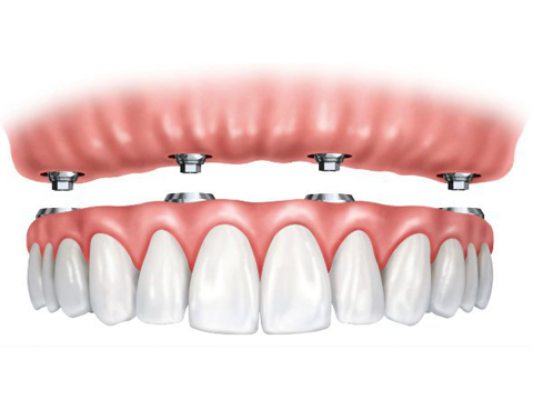 Implant Supported Dentures