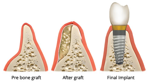 bone grafting for implants illustration