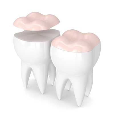dental onlay illustration