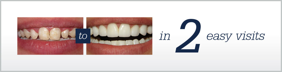 Lumineers Porcelain Veneers Before After