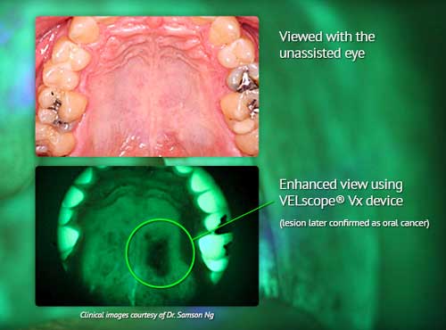 Velscope Oral Cancer Lesion