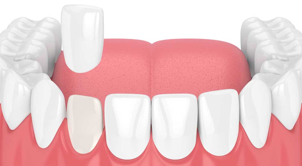 Porcelain veneer procedure illustration