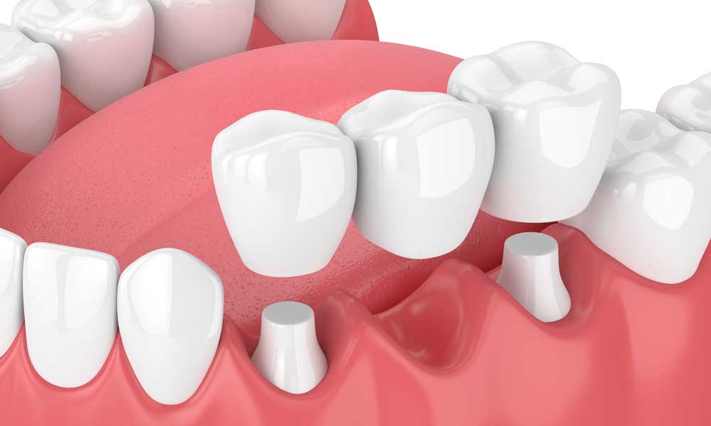 Dental bridges procedure illustration