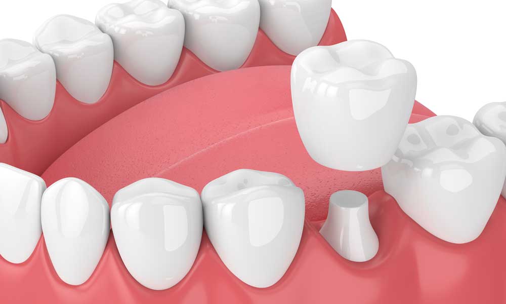 Dental crowns procedure illustration