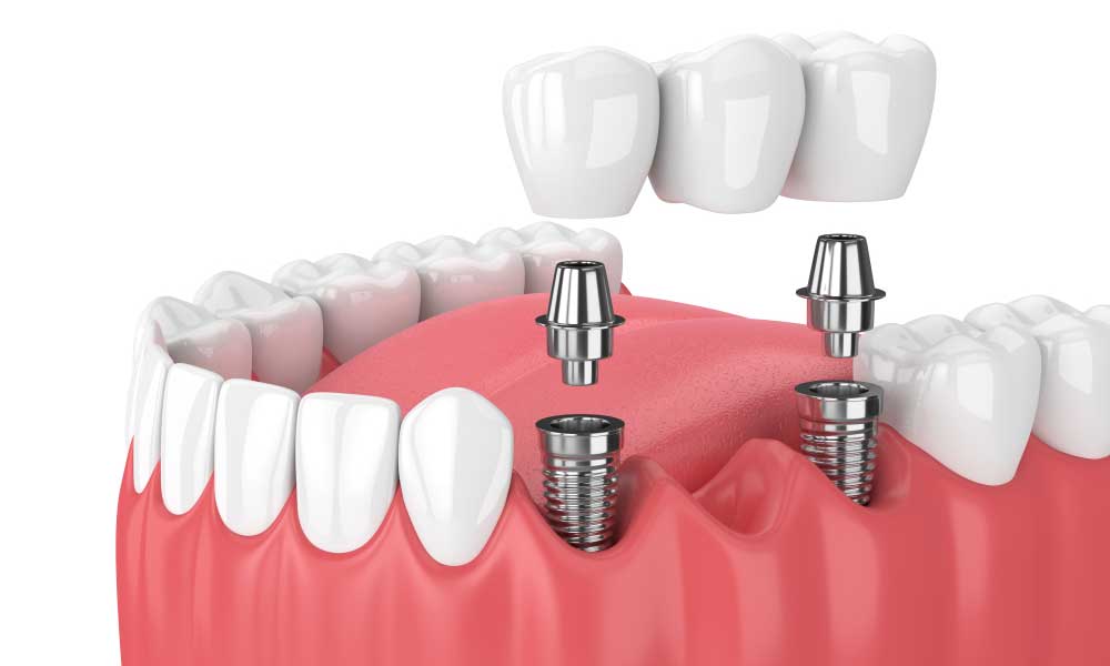 Dental bridge supported by dental implants illustration