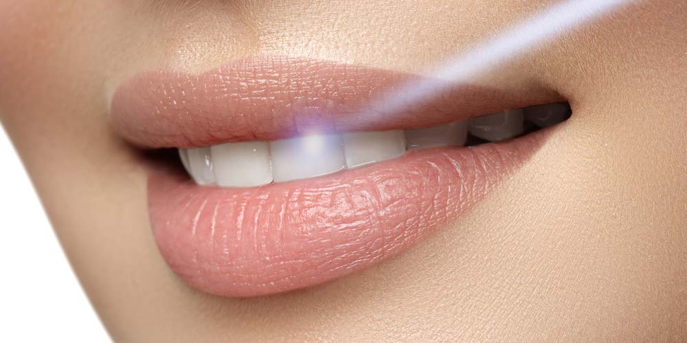 Dental Laser on Women's Teeth