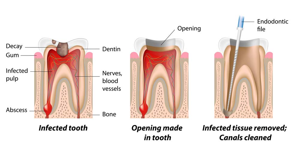 Root Canal Procedure Steps 3 of 6