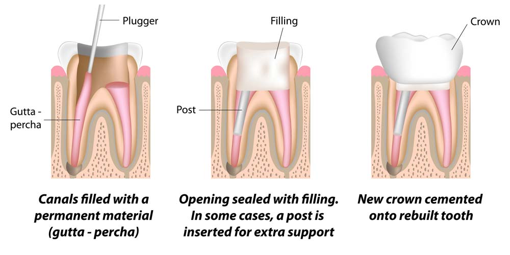 Root canal procedure steps 6 of 6